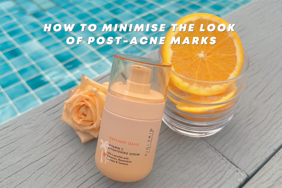 How To Minimise The Look Of Post acne Marks S I G I S K I N how-to-minimise-the-look-of-post-acne-marks-s-i-g-i-s-k-i-n