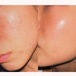 Blissful Radiance Hydrating Anti-Acne Serum Before After Testimonial 2