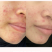 Blissful Radiance Hydrating Anti-Acne Serum Before After Testimonial